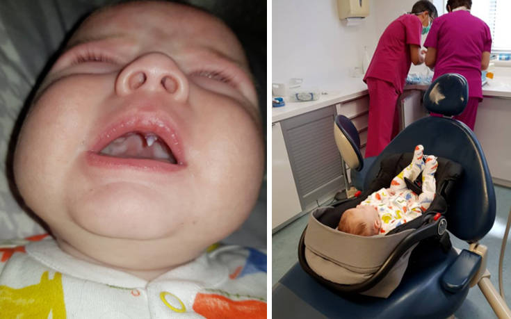 Σοκαρισμένοι γονείς και γιατροί με μωρό που έβγαλε… κυνόδοντα βρικόλακα